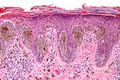 Spitz-nevus-H-E-stain