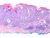 Malignant-melanoma-H-E-stain.jpg