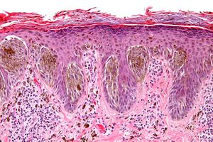 Fichier:Spitz-nevus-H-E-stain.jpg